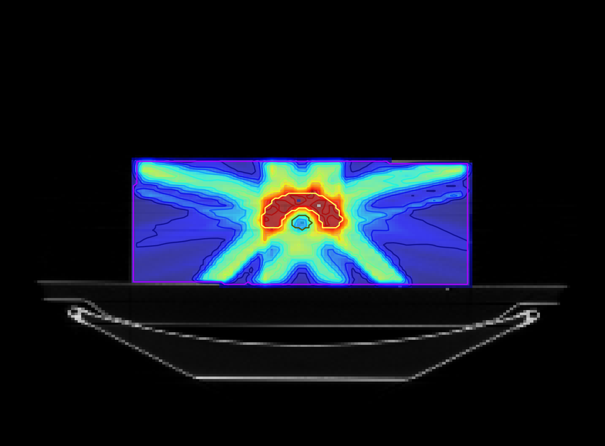 Coronal view on the head-and-neck CT/dose distribution